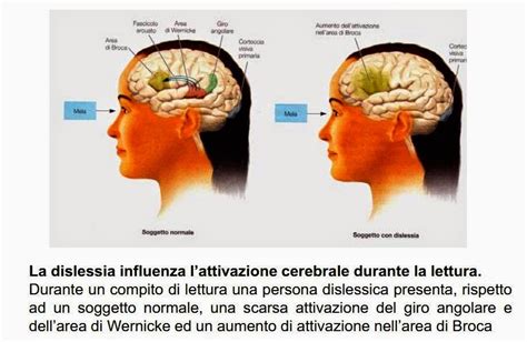 Didattica E Cervello Lateralizzazione Cerebrale Mancinismo E Dislessia