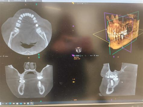 X Nav Machine Dynamic 3d Navigation Minneapolis Oral Surgeons