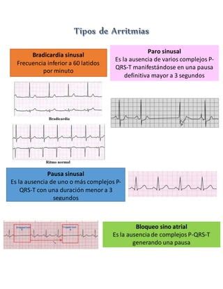 Tipos De Arritmias Pdf