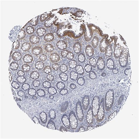 Tissue Expression Of BSG Staining In Colon The Human Protein Atlas