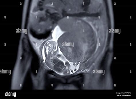 Fetal mri hi-res stock photography and images - Alamy