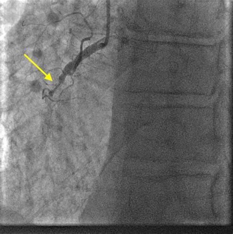 Atypical Presentation Of STEMI With Pericardial Effusion Causing