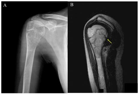 Characteristics Of Giant Cell Tumor Of The Bone In Pediatric Patients