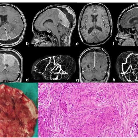 A convexity meningioma. a Preoperative image, MRI without contrast ...