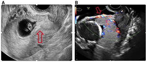 Cesarean Scar Ectopic Pregnancy Nuances In Diagnosis And Treatment