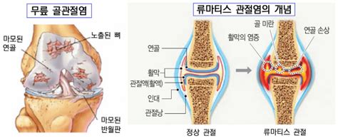 관절염 조조강직 퇴행성 30분내 Vs 류마티스 1시간 이상 서울경제