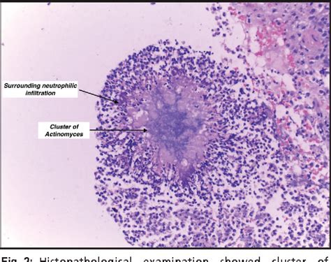 Figure 2 from Pulmonary actinomycosis masquerading as lung cancer: A ...