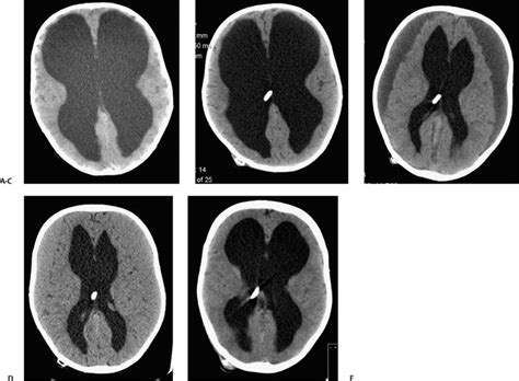 Communicating Hydrocephalus | Neupsy Key