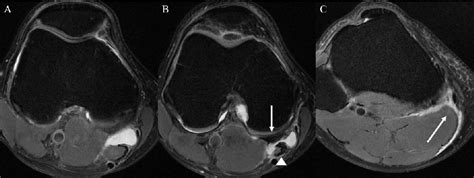 Figure From Assessment Of Imaging Factors Associated With Bakers