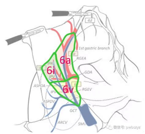 胃癌No 6组淋巴结分布与清扫技巧