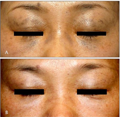 Figure 3 From Q Switched Ndyag Laser Therapy Of Acquired Bilateral