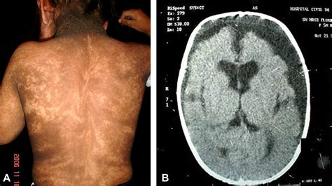 The Group Of Epidermal Nevus Syndromes Journal Of The American