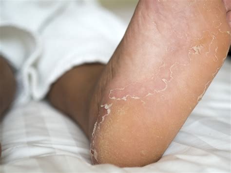 Itchy Blister On Side Of Foot Hotsell Emergencydentistry