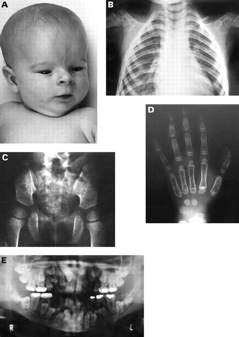 Cleidocranial Dysplasia Clinical And Molecular Genetics Journal Of Medical Genetics