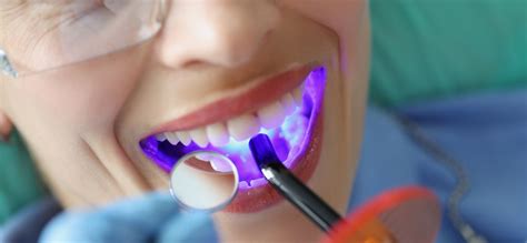 Dental Sealants | San Ramon, CA | Pro Smile Dental Care