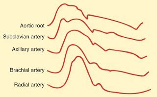 Pulsus Alternans Definition Symptoms Causes Treatment Health Care