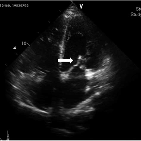 Pdf Chordae Rupture And Acute Mitral Regurgitation Associated With