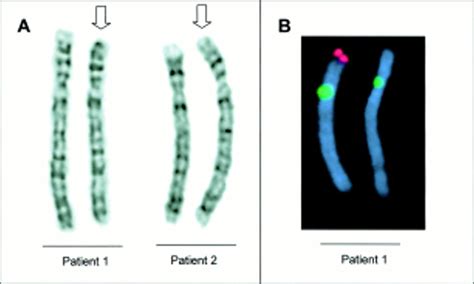 Two Further Cases Of Whs With Unbalanced De Novo Translocation T48