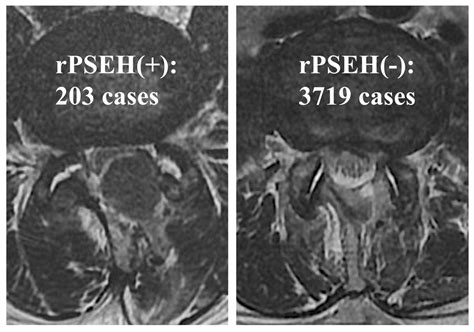 Jcm Free Full Text Increased Surgical Experience In Microendoscopic Spinal Surgery Can