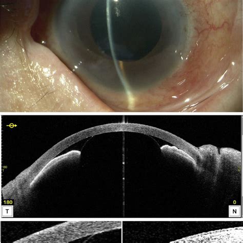 Slit Lamp A And As Oct B Findings Od 1 Month After The Vitrectomy Download Scientific