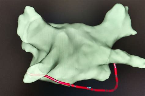 Ablação De Fibrilação Atrial Pachon Arritimias Dr Pachon