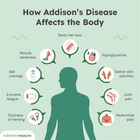 What Is Addison’s Disease? Symptoms, Causes, Diagnosis, Treatment, and