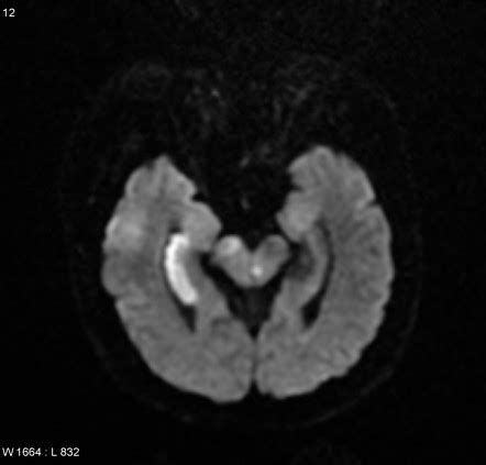 Posterior Choroidal Artery Stroke Radiology Reference Article | Sexiz Pix