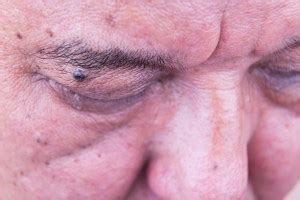 Eyelid Lesion Removal – Meadows Eye Physicians & Surgeons