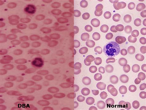 [figure Diamond Blackfan Anemia Image Courtesy Dr Chaigasame