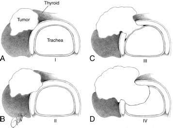 Surgery For Locally Advanced Thyroid Cancer Larynx Tracheal Invasion