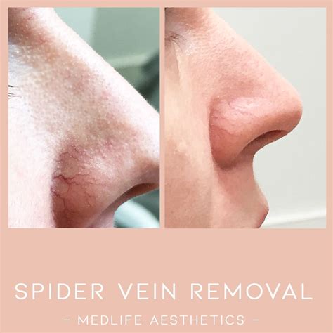 Fabulous Spider Vein Nose Transformation On One Of Our Lovely Clients