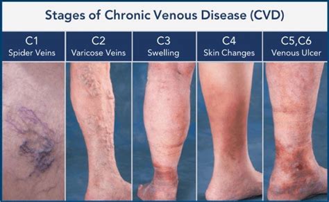 Venous Disorders