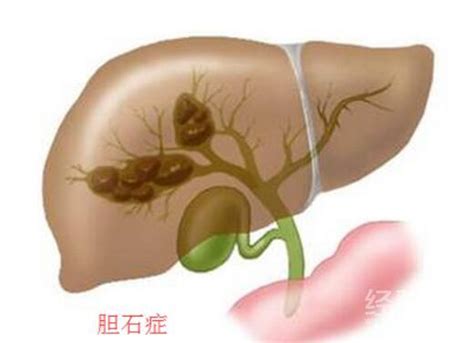 胆结石吃什么好 饮食上要注意这些禁忌！ 健康经验本