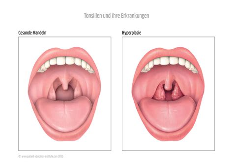 Mandeln Tonsillen Rachenmandeln Und Gaumenmandeln HNO Praxis Sarnen