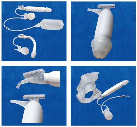 Insertion Of Inflatable Penile Prosthesis In The Neophallus Of Assigned