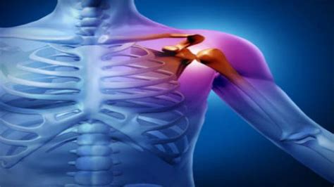 psoriatic arthritis psa support program arthritis australia