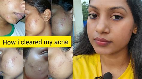 How I Cleared My Acne My Acne To Clear Skin Journey With Pictures