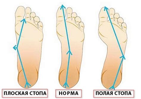 ЛФК при плоскостопості - комплекс вправ для занять - Київська лікарня ...
