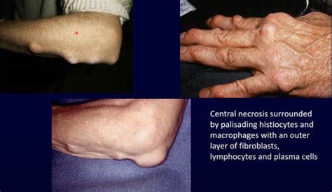 Rheumatoid Arthritis Flashcards Quizlet