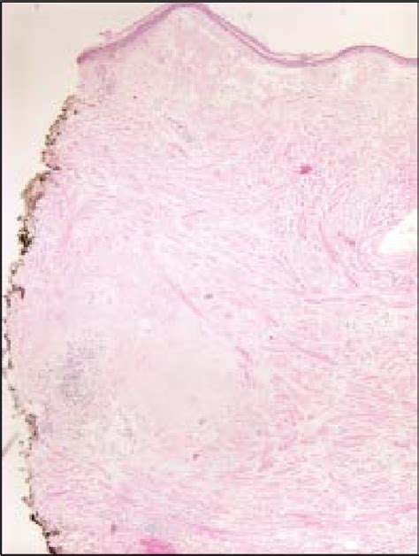 Figure 2 From Primary Localized Cutaneous Nodular Amyloidosis And Crest Syndrome A Case Report