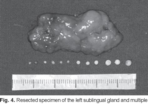 Figure 4 From A Case Of Multiple Sialoliths In Sublingual Gland