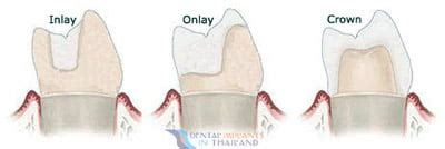 Quality Dental Inlays and Onlays | Price Comparison