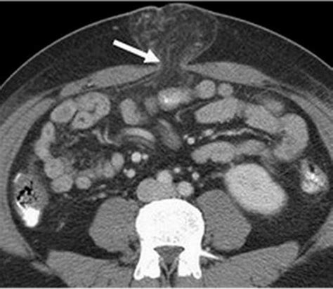 Ventral Hernia - Pictures, Repair, Symptoms, Surgery, Types