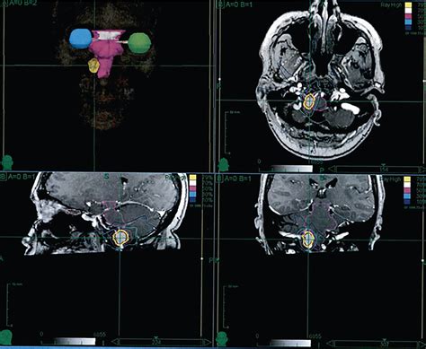 Foramen magnum meningioma – upfront radiosurgery | Radiology Key