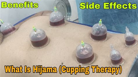 Hijama Wet Cupping Hindi Delhi My First Hijama Session Hijama