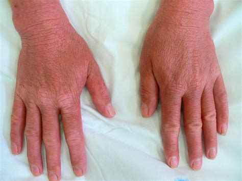 Severe Form Of Atopic Dermatitis With Lichenification Download