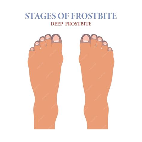 Premium Vector | Frozen toes stages of frostbite of fingers healthcare ...