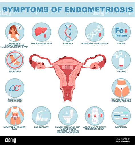 Symptom Of Endometriosis Reproductive Disease Vector Illustration Stock Vector Image And Art Alamy