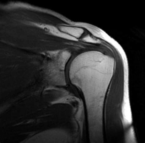 MRI Sequences T1 Weighted Mri Pulse Sequence MRI Glossary T2 Vs