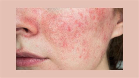 Treating Rosacea Springwell Clinic